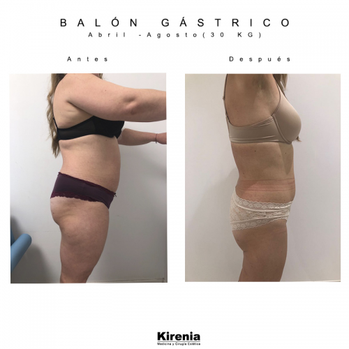 Bal�n g�strico 5 meses